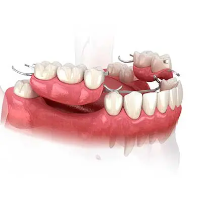Partial dentures