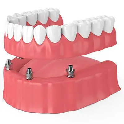 Implant-supported dentures