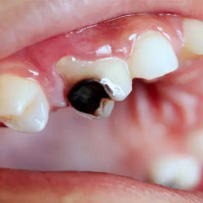 Extensive decay or infection