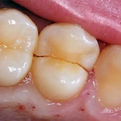 A deeply damaged tooth