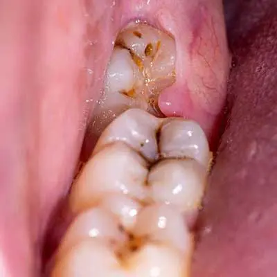 Impacted wisdom teeth