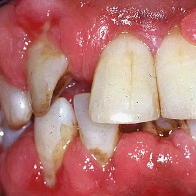 Loss of gum and bone support