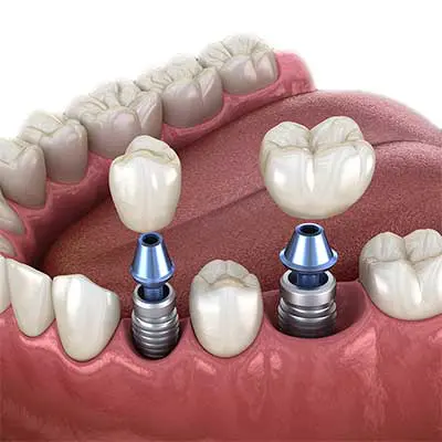 A restorative treatment plan