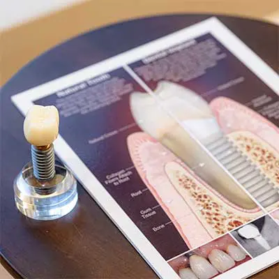 Dental implant restoration model