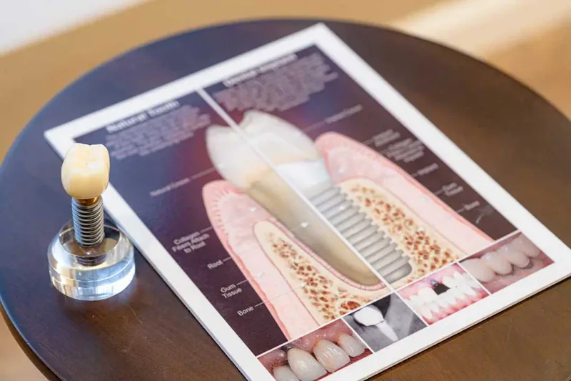 Dental implant restoration
